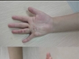 綿陽萬江眼科醫院成功為四歲兒童恢復右手指功能