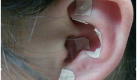 小小耳穴，大有乾坤——中醫眼科耳穴壓豆法