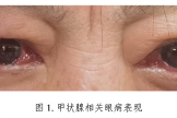 “國際甲狀腺知識宣傳周”，一起科學認識甲狀腺相關眼病