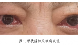 “国际甲状腺知识宣传周”，一起科学认识甲状腺相关眼病