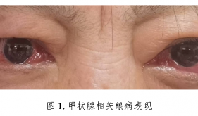 “國(guó)際甲狀腺知識(shí)宣傳周”，一起科學(xué)認(rèn)識(shí)甲狀腺相關(guān)眼病