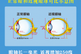 健康科普｜當近視超過600度，你的眼睛需要更多呵護