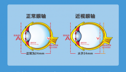 健康科普｜当近视超过600度，你的眼睛需要更多呵护