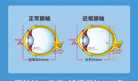 健康科普｜當近視超過600度，你的眼睛需要更多呵護