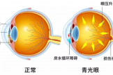 健康科普｜青光眼患者守護視力，從堅持滴眼液開始