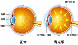 健康科普｜青光眼患者守護視力，從堅持滴眼液開始