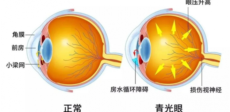健康科普｜青光眼患者守護(hù)視力，從堅(jiān)持滴眼液開(kāi)始