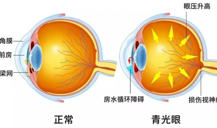 健康科普｜青光眼患者守护视力，从坚持滴眼液开始