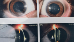 攜手守護，與罕見病家庭共戰(zhàn)并發(fā)性白內(nèi)障