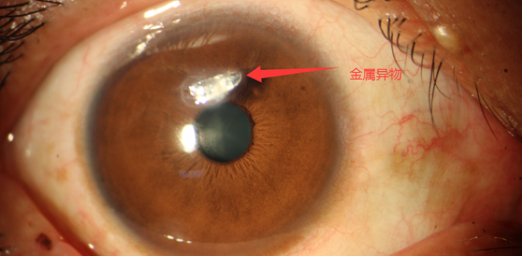 金屬異物傷眼，醫(yī)生緊急手術(shù)挽救工人視力