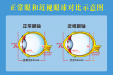 健康科普｜开学季：勿焦虑，理性看待孩子的近视度数增长