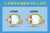 健康科普｜開(kāi)學(xué)季：勿焦慮，理性看待孩子的近視度數(shù)增長(zhǎng)