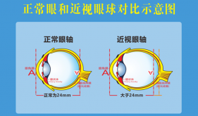 健康科普｜開學季：勿焦慮，理性看待孩子的近視度數(shù)增長