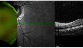 健康科普｜糖尿病患者建议每年定期检查眼底