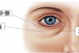 眼袋 + 泪沟找上门？别只知道去脂填充！一篇看懂