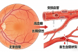 糖尿病性眼病：高血糖对眼睛的危害