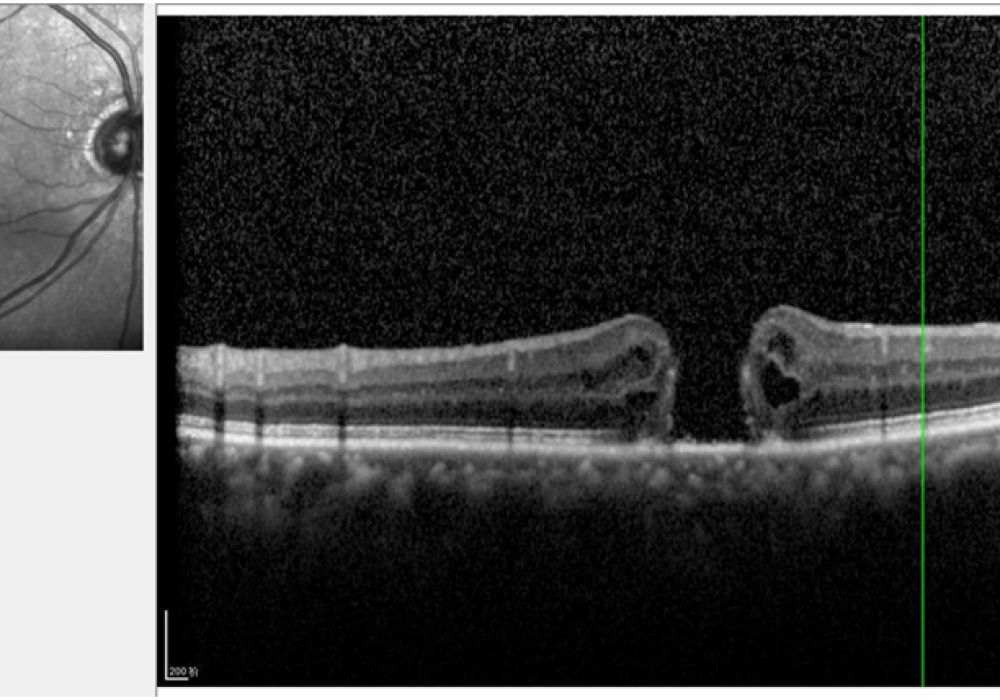 眼睛的“精密底片”出现了裂口？一文了解黄斑裂孔