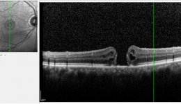 眼睛的“精密底片”出现了裂口？一文了解黄斑裂孔