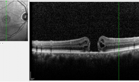 眼睛的“精密底片”出现了裂口？一文了解黄斑裂孔