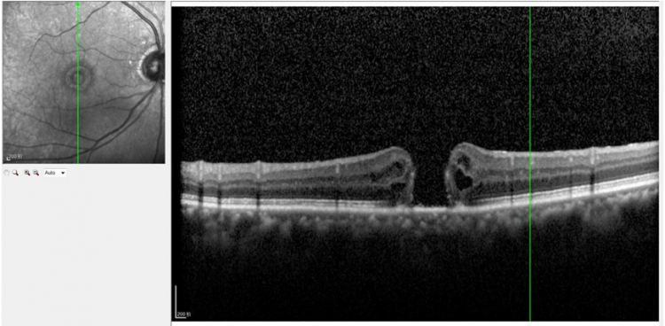 眼睛的“精密底片”出现了裂口？一文了解黄斑裂孔