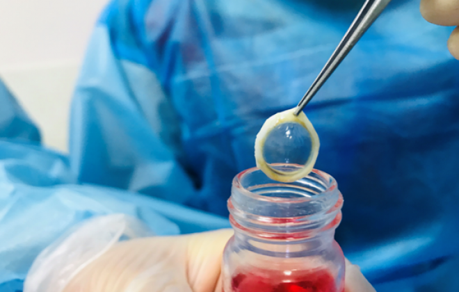 角膜移植的“材料”从哪来？清明，致敬角膜捐献者